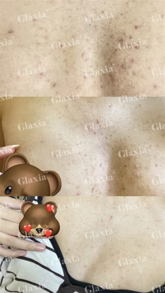 Glaxia before and after — customer result 2